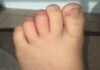 Bambino di 5 anni punto dal bruco Megalopyge opercularis
