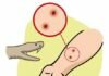 Muore Dopo il Morso del Serpente Bruno Orientale Uomo muore per il morso del serpente bruno orientale